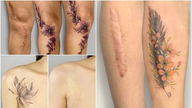 Tetovira ožiljke i tako pomaže ljudima vratiti samopouzdanje
