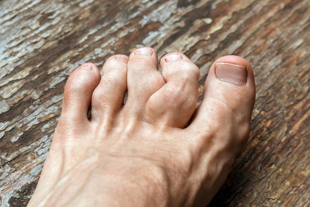 Gouty,Toes.,Toes,Affected,By,Gout,-,A,Disease,In