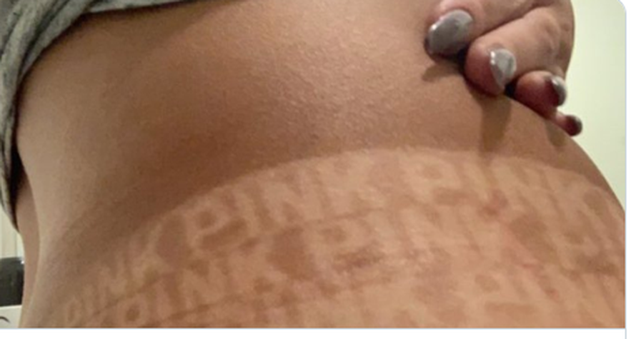 Sprej za tamnjenje je nanosila preko gaćica, pa sad ima logo