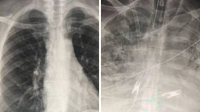 Ovo su pluća dva pacijenta koji imaju koronu. Jedan se cijepio, drugi nije. Razlika je ogromna