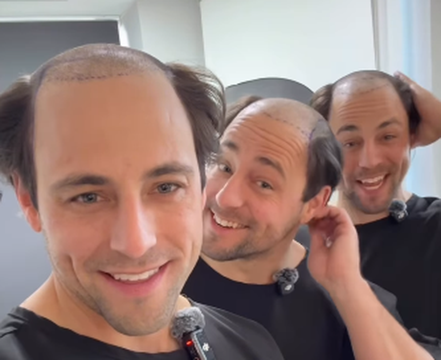 Trojčeki otputovali u Tursku na transplantaciju kose: 'Ne može samo jedan imati dobru frizuru'