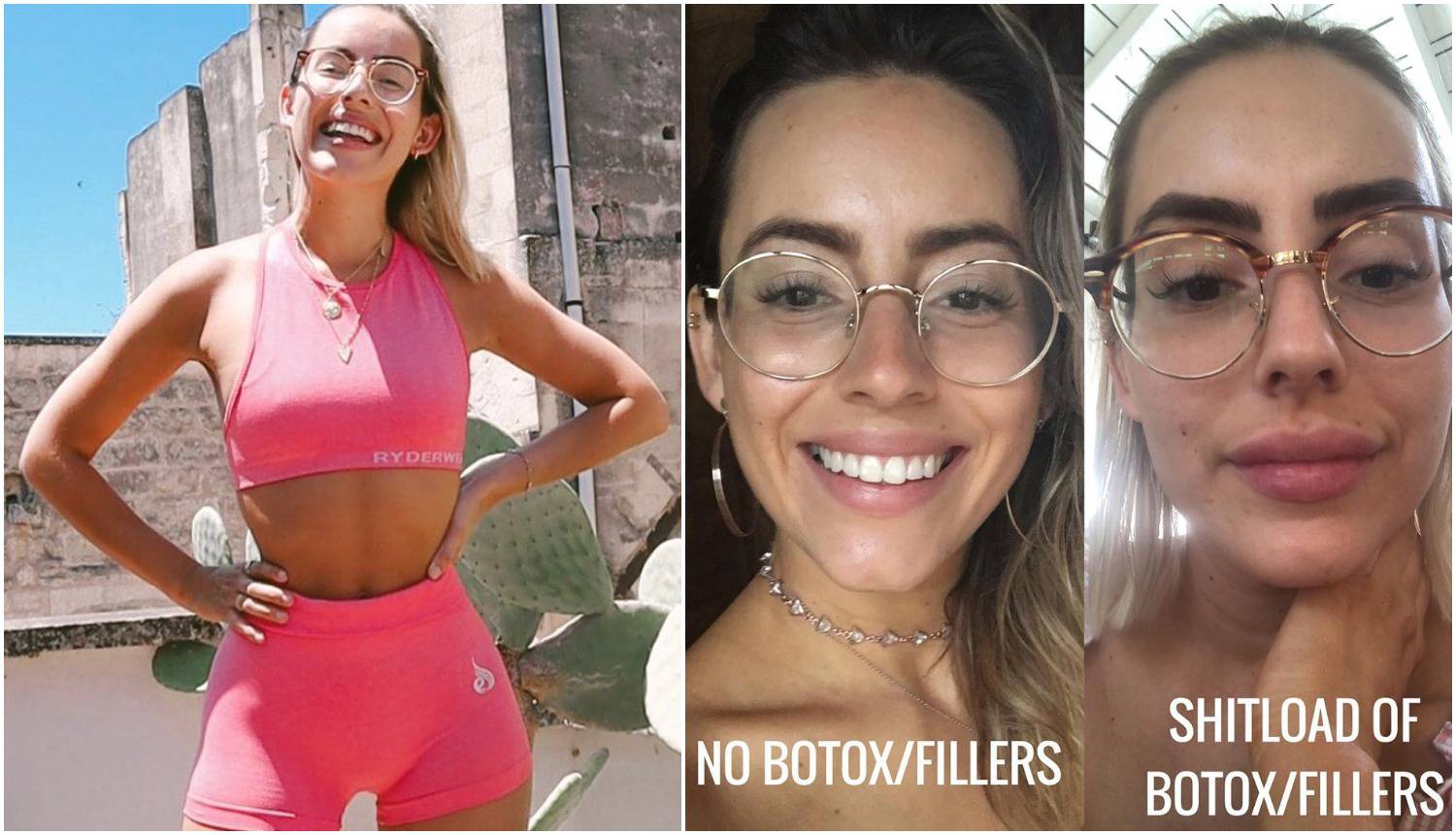 Fitness blogerica uklonila filere i botoks vrijedne 46.000 kuna