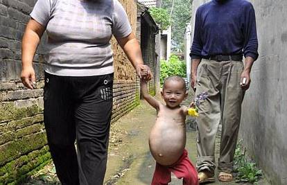 Kina: Djevojčici izvadili iz trbuha fetus brata blizanca