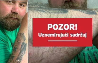 Iz ruke mu počeli izlaziti vijci: Bivši UFC-ov prvak zbog loše operacije ima groznu infekciju