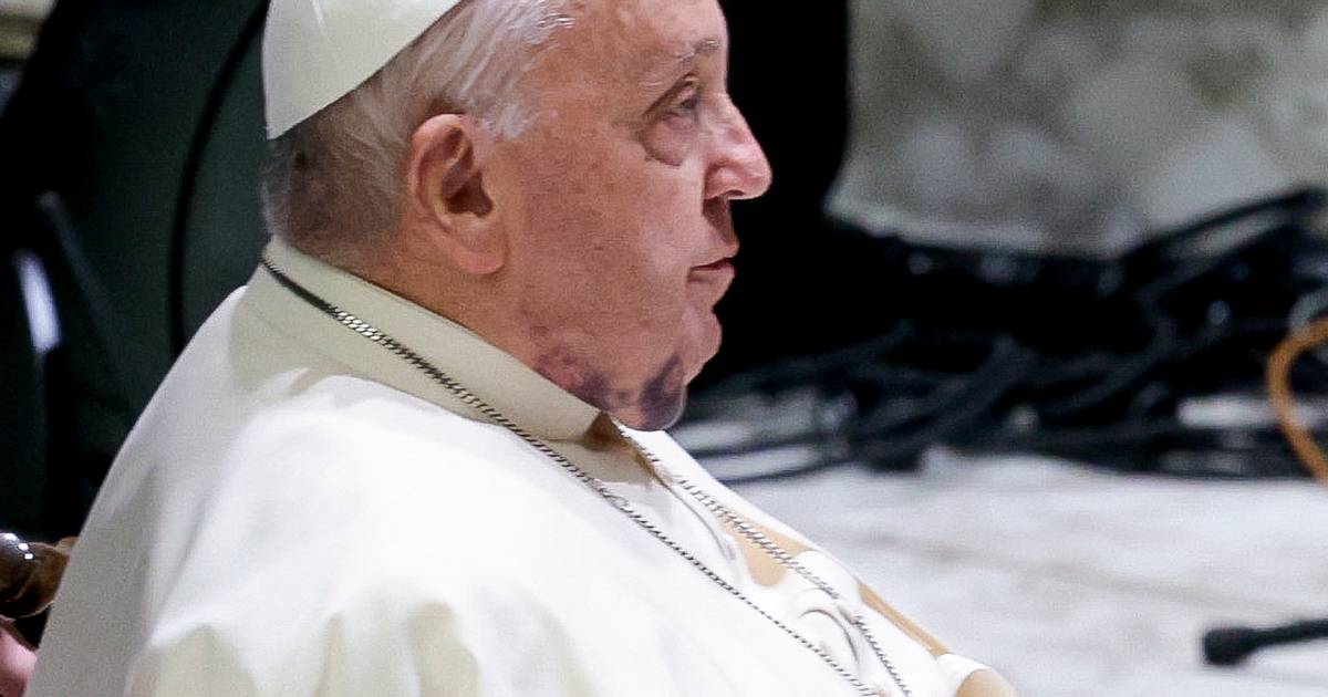 The Pope led the mass. He had a mysterious bruise on his chin