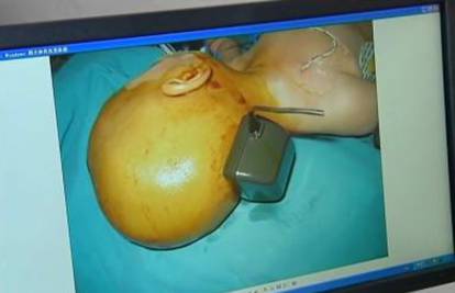 Dječaku (1) iz Kine liječnici iz glave vadili punjač za mobitel