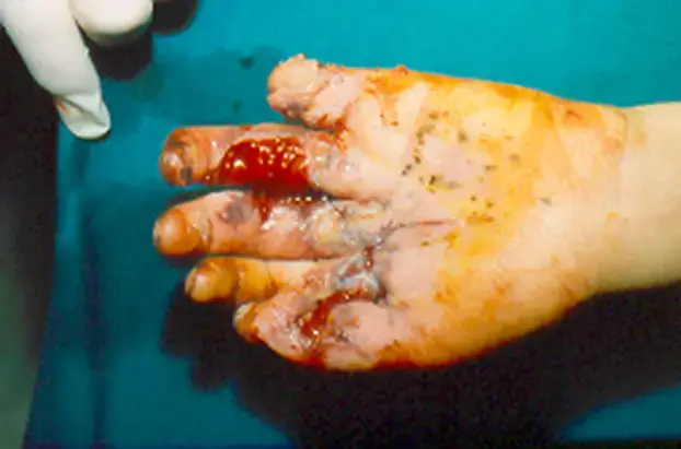 Evo zašto su zabranili petarde: Ovako izgledaju ruke djece koja su stradala od pirotehnike