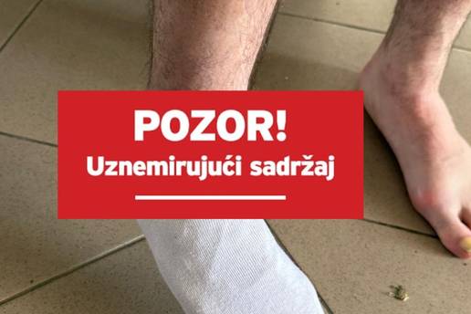 FOTO Pogledajte kako izgleda noga biv&scaron;eg hajdukovca nakon utakmice Prve NL u Sesvetama