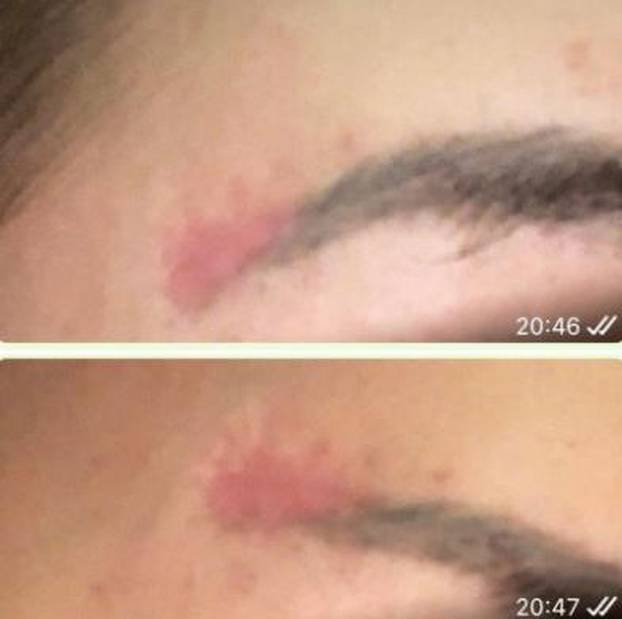 Na istog se estetskog kirurga žalila i Kristina Mandarina. Pogledajte kako je izgledala