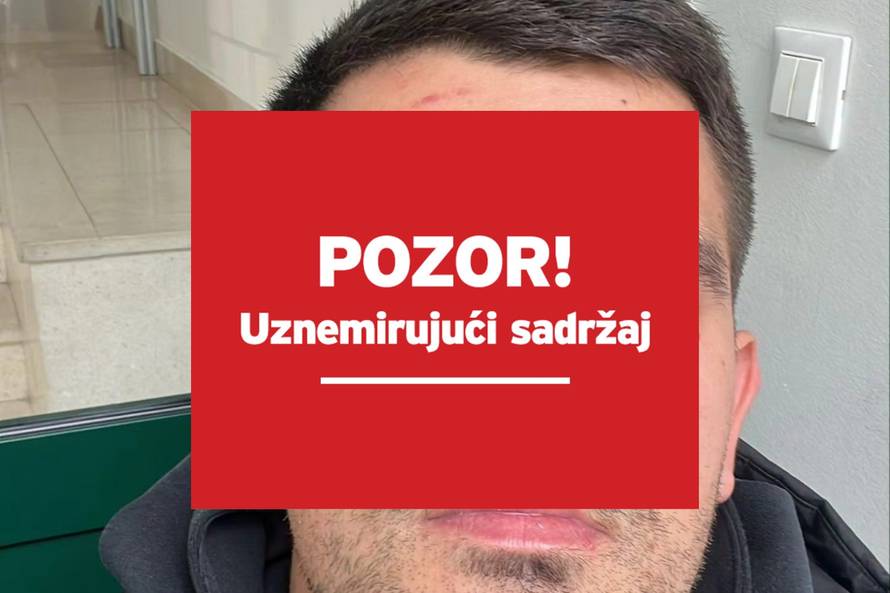 VIDEO Kaos u Orebiću: Šef kluba ugrizao suparnika za oko! Evo kako izgledaju napadnuti igrači