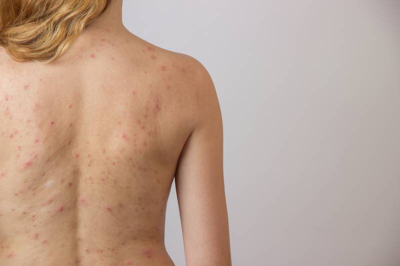 Young girl with acne, with red spots on the back