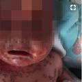 Opasan poljubac majke: Bebi je cijelo tijelo u strašnom  herpesu