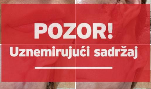 FOTO Potresne ispovijesti žrtava zagrebačkog estetskog kirurga: 'Osakaćene smo za cijeli život'