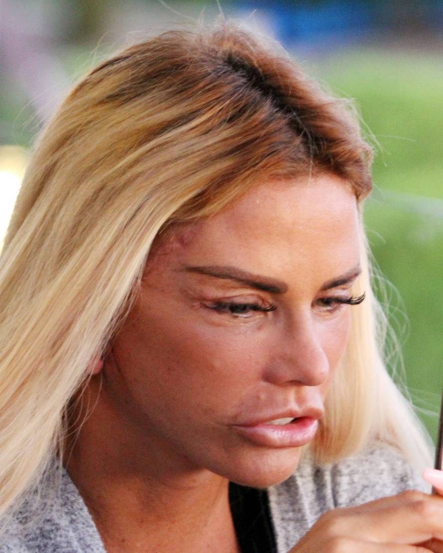 *PREMIUM-EXCLUSIVE* MUST CALL FOR PRICING BEFORE USAGE  - The British Glamour Model Katie Price aka Jordan is in recovery mode showing the scars from the results of her facial procedure out in Turkey