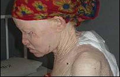 U Tanzaniji ubijaju albine jer ih smatraju prokletima