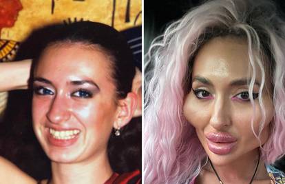 Prije i poslije: Žena s najvećim jagodicama na svijetu pokazala svoju drastičnu transformaciju
