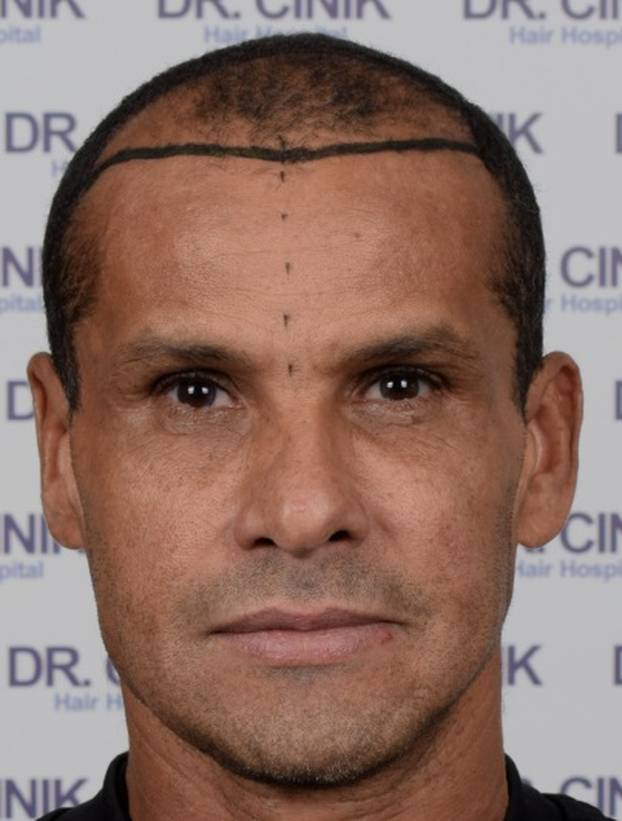 FOTO Ove nogometne zvijezde presadile su kosu. Pogledajte kako su izgledale prije i poslije