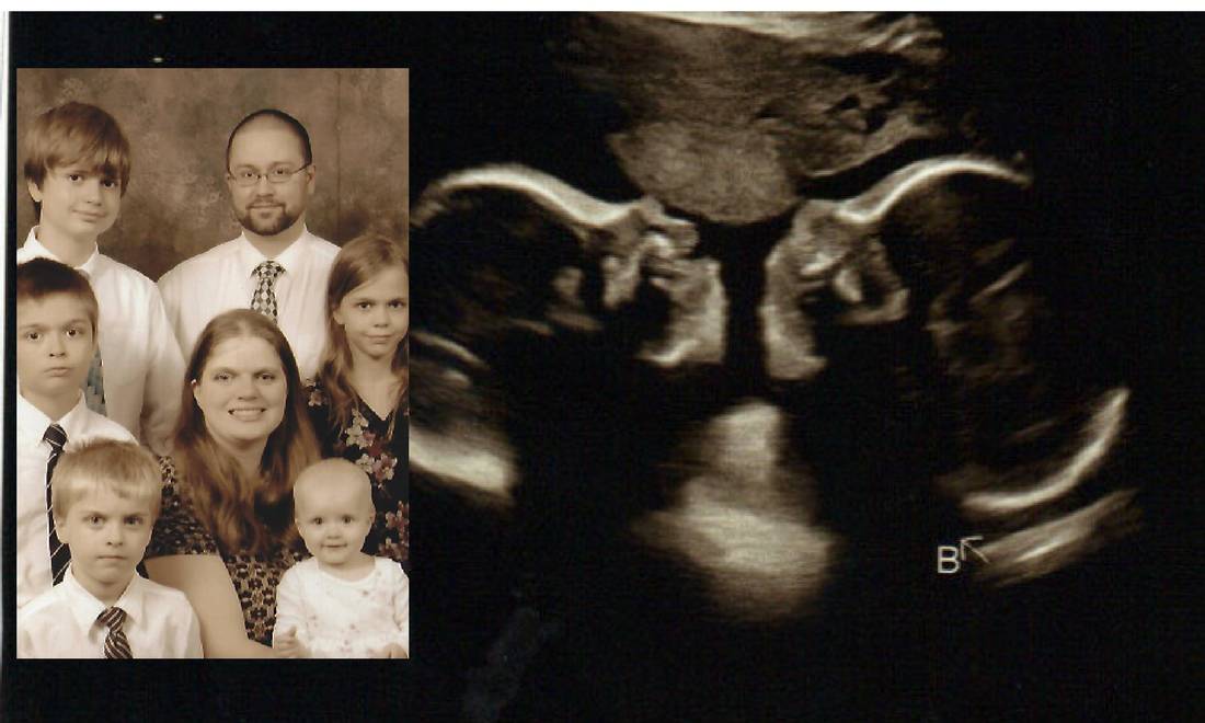 Već imaju petero djece, a sada su još dobili sijamske blizance