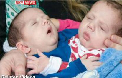 Liječnici uspjeli razdvojiti braću sijamske blizance