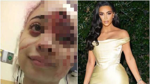 Metak je pogodio tinejdžericu u lice, Kim joj želi platiti liječenje
