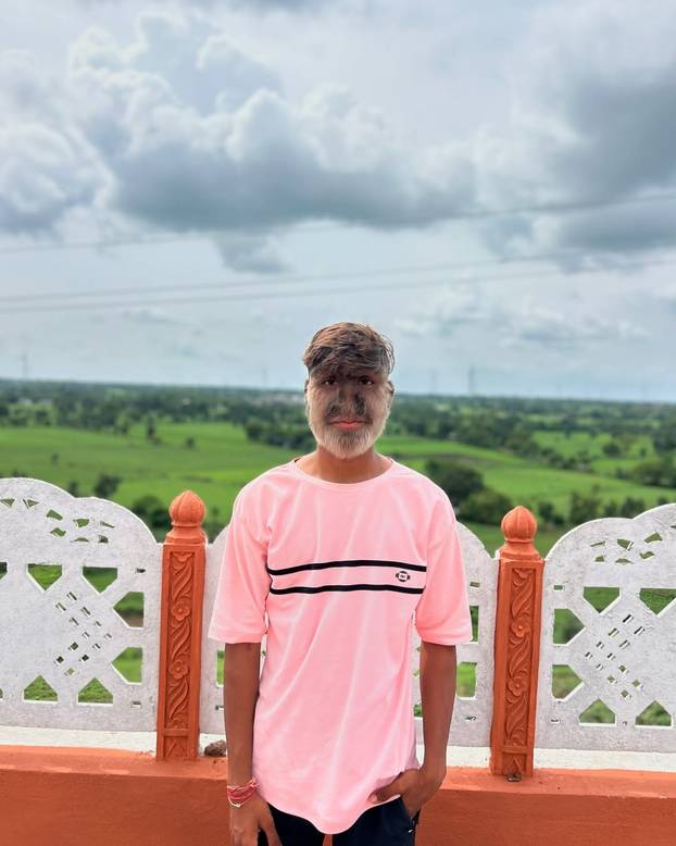 FOTO Ovaj mladić (18) pati od sindroma vukodlaka: U školi me sprdaju, ali volim svoje dlake...