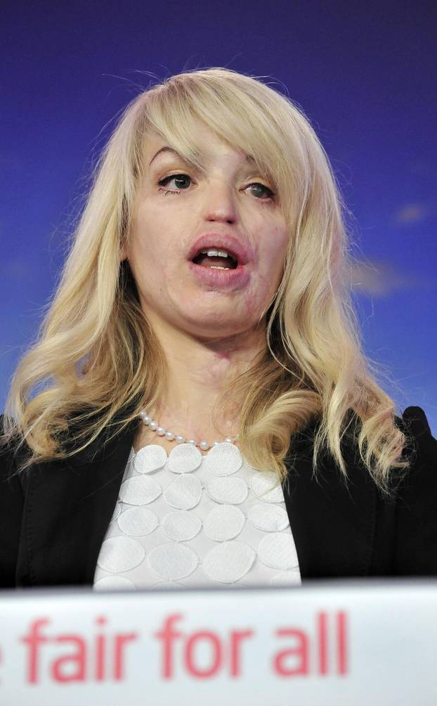 London: Djevojka koju je de?ko polio kiselinom aktivna u politici