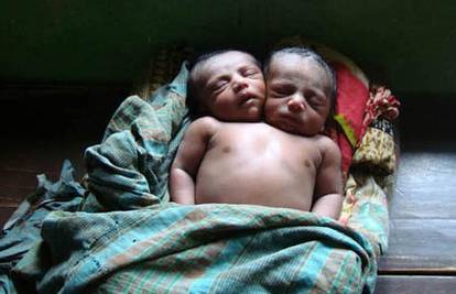 Beba s dvije glave izazvala pravu maniju u Bangladešu