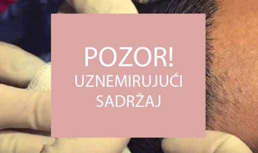 Strašno: Iz glave mu je izvadila tvrdu cistu formiranu kao rog