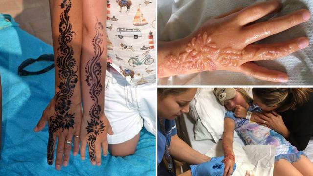 Tetoviranje crnom kanom curici je spržilo kožu na cijeloj ruci
