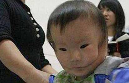 Beba iz Kine zbog bolesti izgleda kao da nosi masku