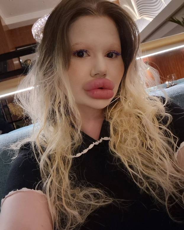FOTO Žena s najvećim usnama na svijetu otkrila kako je nekoć izgledala: Šok! Bila si prekrasna