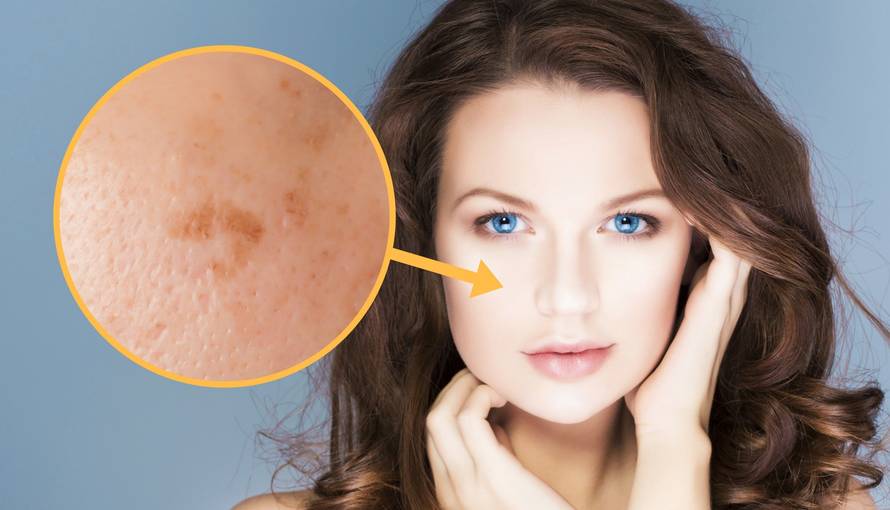 Moguće je da imate ovo kožno stanje, a ne znate - melazmu