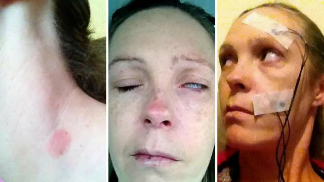 Majka troje djece zbog krpelja ostala paraliziranog lica i oka