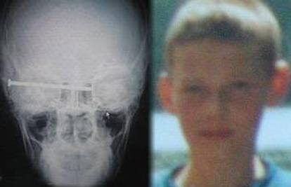 Dječak se upucao pištoljem za čavle u glavu i preživio