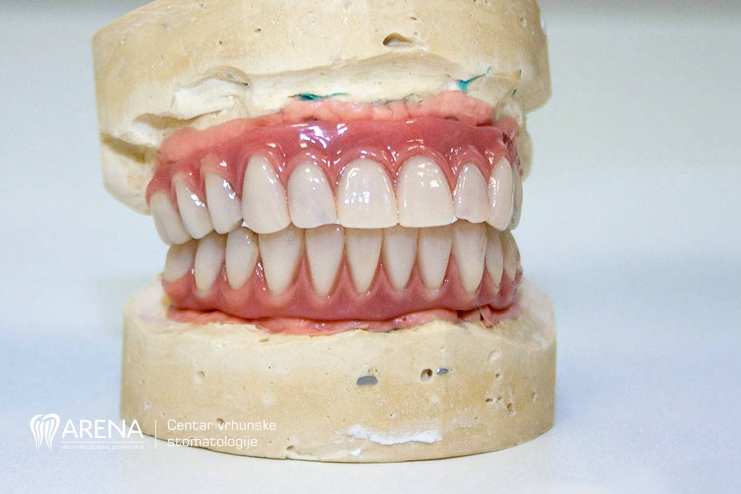 Muči vas nedostatak zubi? Potražite trajno rješenje