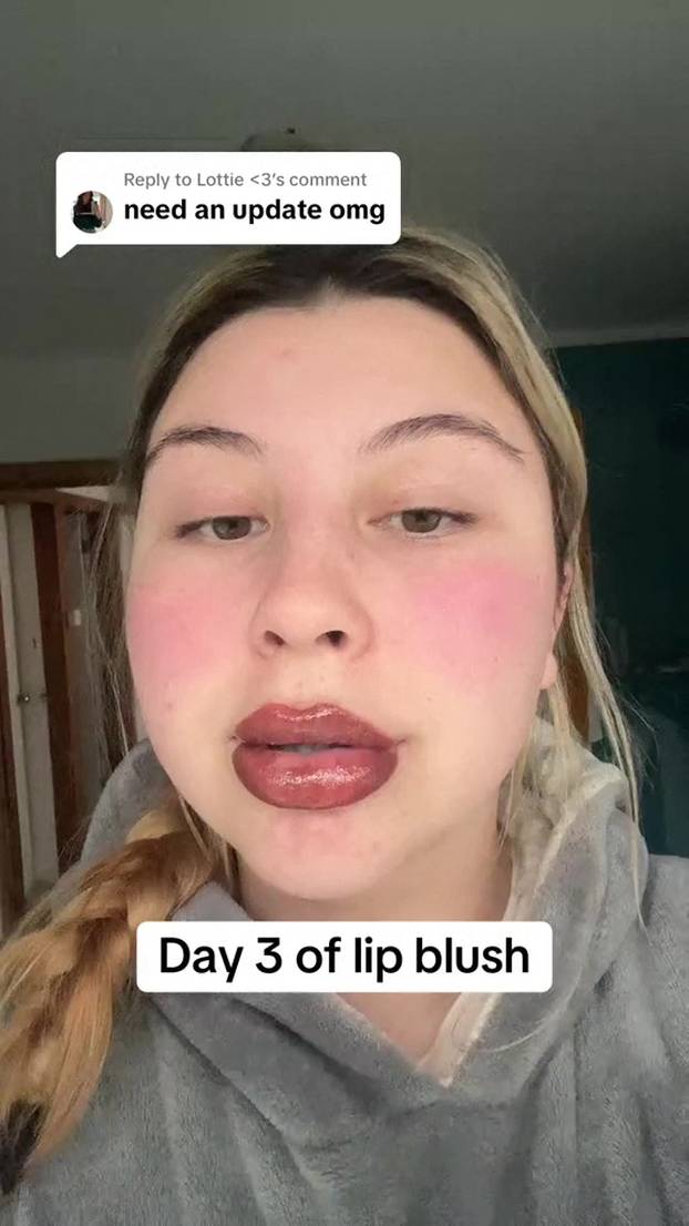 EXCLUSIVE: VIDEO: ‘Extreme allergic reaction to lipstick tattoo left me looking like Monsters Inc character’