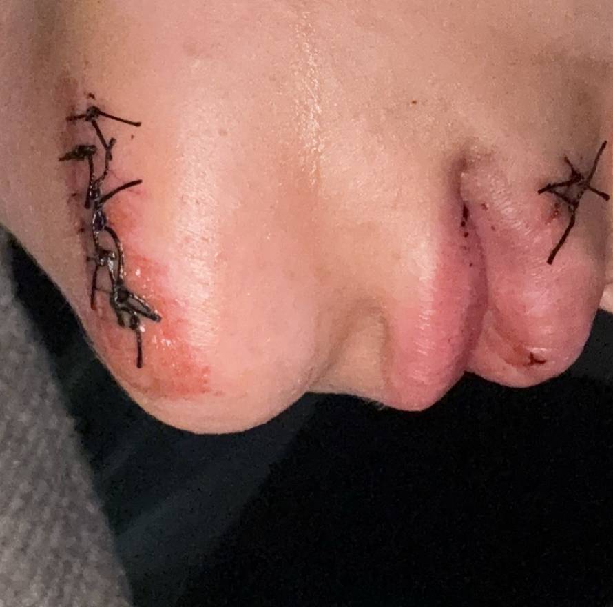 UŽAS U BEOGRADU Pretukli Hrvate u novogodišnjoj noći: 'U Zemunu su mi krivo zašili jezik'