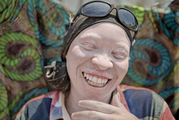 Persecuted: Albino People Seek Refuge From Vicious Body Part Traffickers