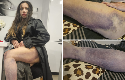 Super Silva za 24sata: Znam tko me napao, bilo je iznenada i s leđa. Jedna noga mi je uništena