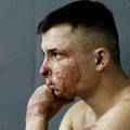 Ekskluzivno: U ranama vojnika vidi se sva patnja Ukrajine...