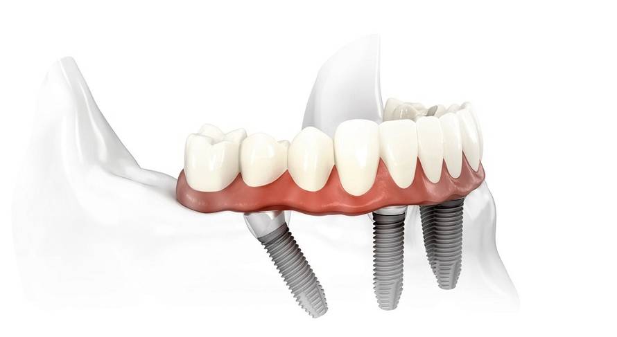 Kada je potreban sinus lift prije ugradnje implantata?