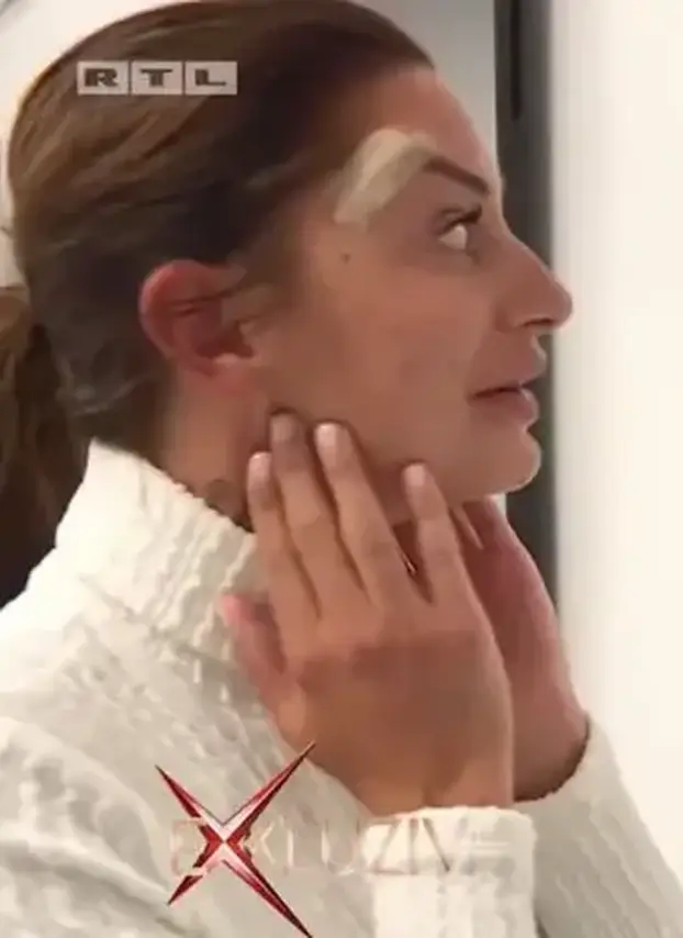 Na istog se estetskog kirurga žalila i Kristina Mandarina. Pogledajte kako je izgledala