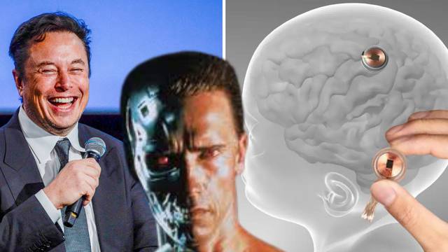Muskova firma ugradila čovjeku čip u mozak: Dobro se oporavlja