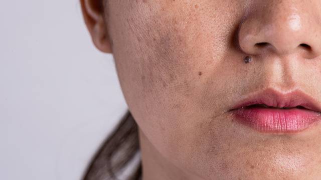 Trik za prekrivanje mrlja na koži - ali bez stavljanja tone pudera