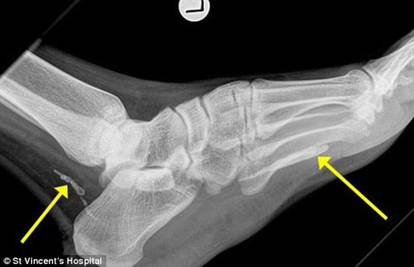 Užasni bolovi: Muškarcu u peti četiri godine živio crv od metra