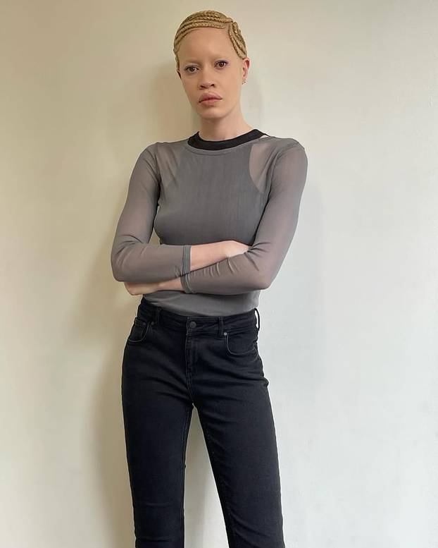 FOTO Afrikanka s albinizmom osvaja modnu industriju: 'Često privlačim znatiželjne poglede'