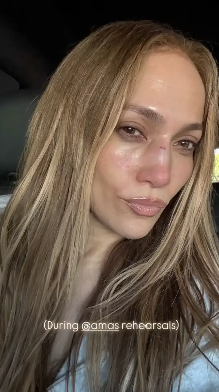 FOTO Gadna ozljeda lica Jennifer Lopez: U pomoć joj priskočio poznati estetski kirurg