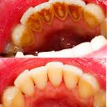 Riješite se zubnog kamenca doma i odstranite loš zadah