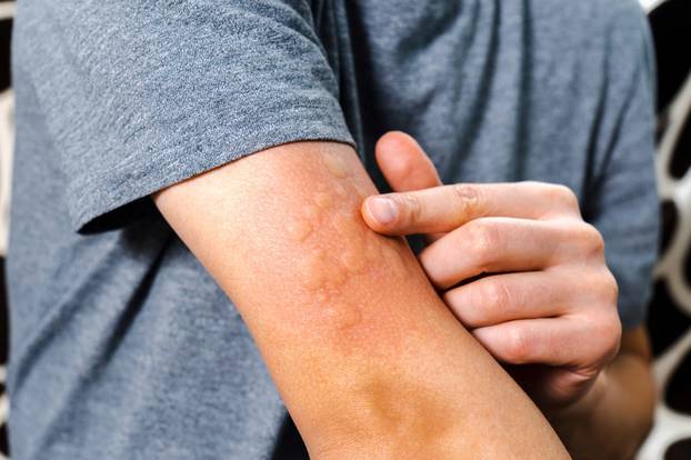 Skin,Rash,And,Swelling,On,Man,Arm,,Immunizations,Prevent,Infectious