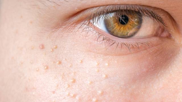 Milia (Milium) - pimples around eye on skin.